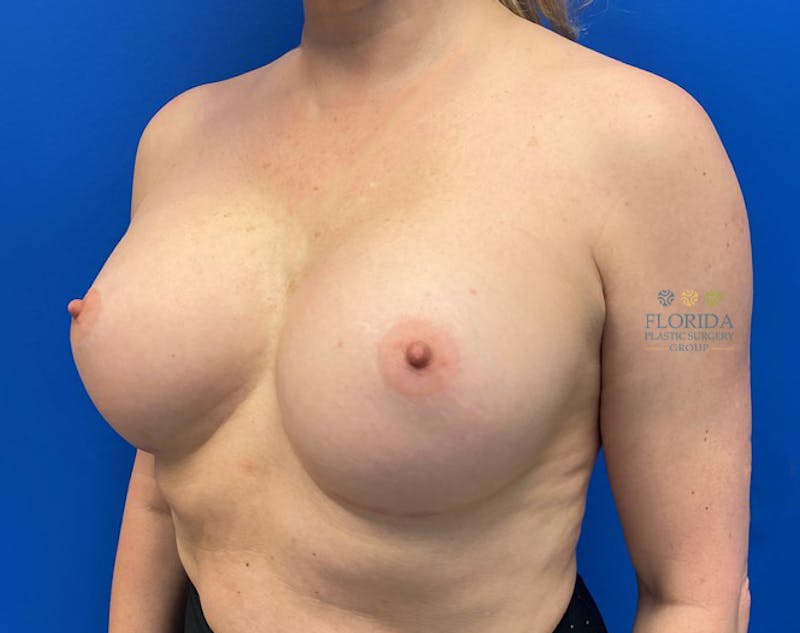 Revision Breast Surgery Before & After Gallery - Patient 154994277 - Image 3