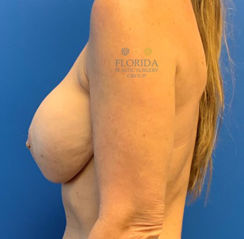 Revision Breast Surgery Before & After Gallery - Patient 154994286 - Image 3