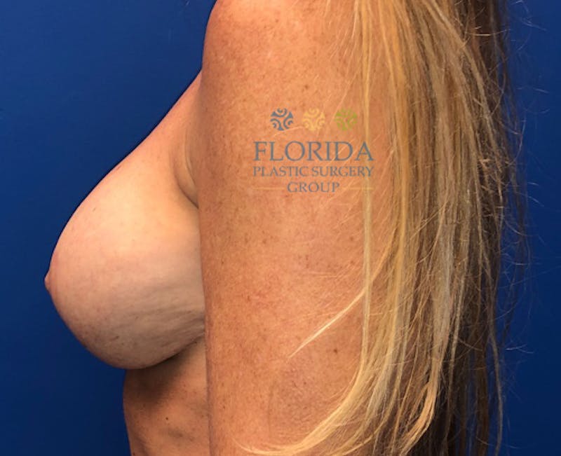 Revision Breast Surgery Before & After Gallery - Patient 154994286 - Image 4