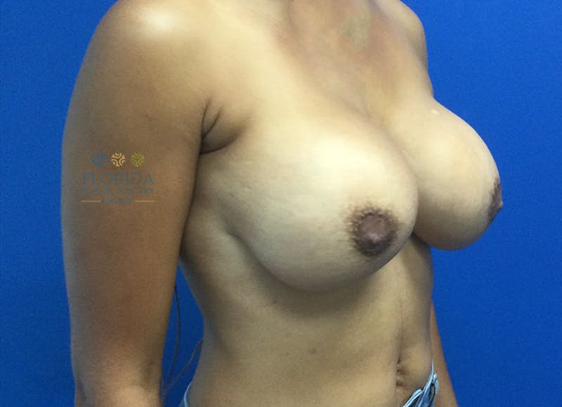 Revision Breast Surgery Before & After Gallery - Patient 154994314 - Image 3