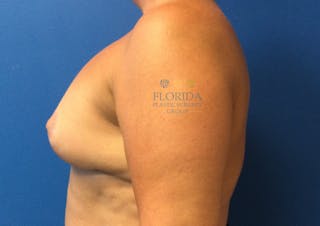 Revision Breast Surgery Before & After Gallery - Patient 154994345 - Image 4