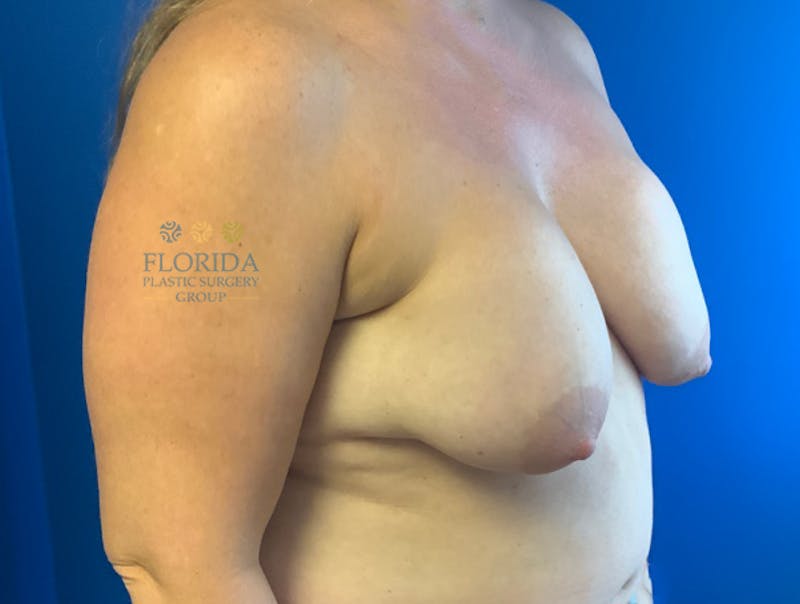 Revision Breast Surgery Before & After Gallery - Patient 154994345 - Image 5