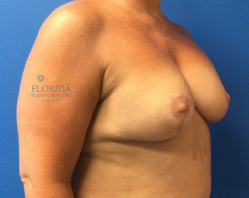 Revision Breast Surgery Before & After Gallery - Patient 154994345 - Image 6