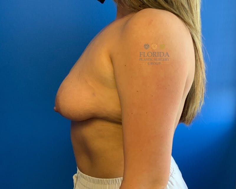 Revision Breast Surgery Before & After Gallery - Patient 154994368 - Image 3