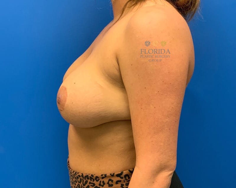 Revision Breast Surgery Before & After Gallery - Patient 154994368 - Image 4