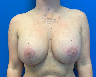 Revision Breast Surgery Before & After Gallery - Patient 154994394 - Image 2