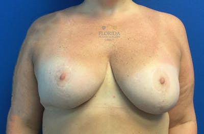 Revision Breast Surgery Before & After Gallery - Patient 154994410 - Image 2