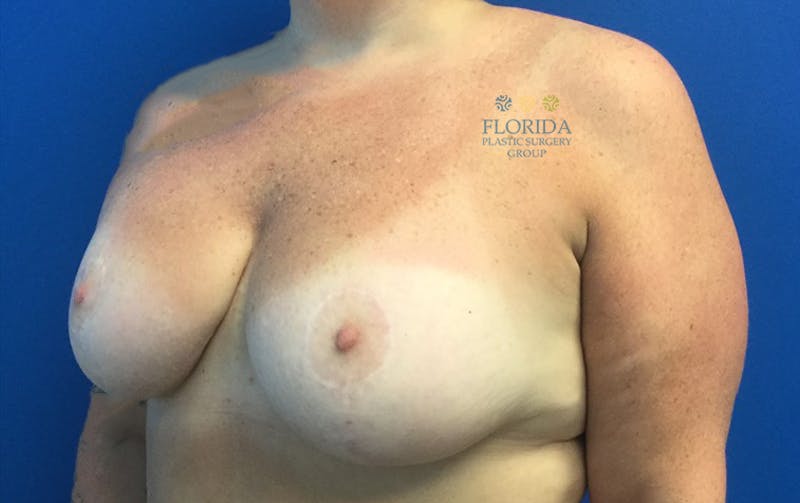 Revision Breast Surgery Before & After Gallery - Patient 154994410 - Image 4