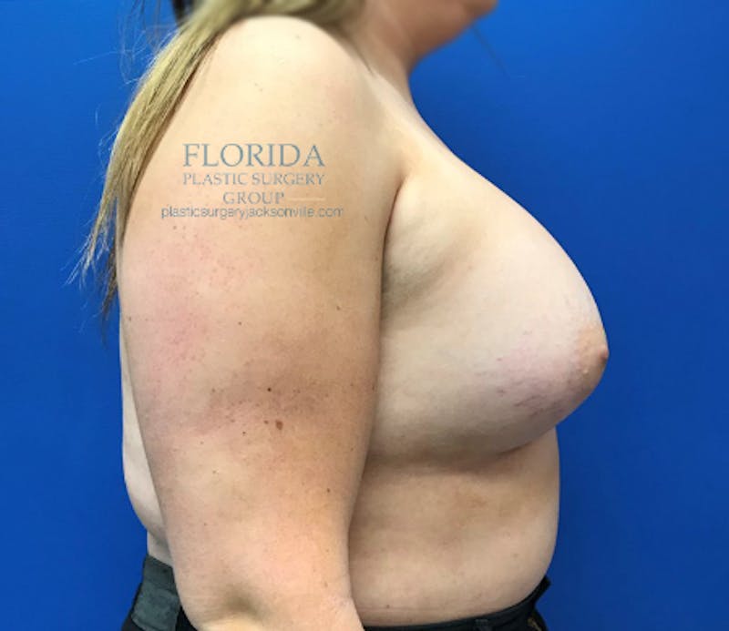 Revision Breast Surgery Before & After Gallery - Patient 154994446 - Image 4