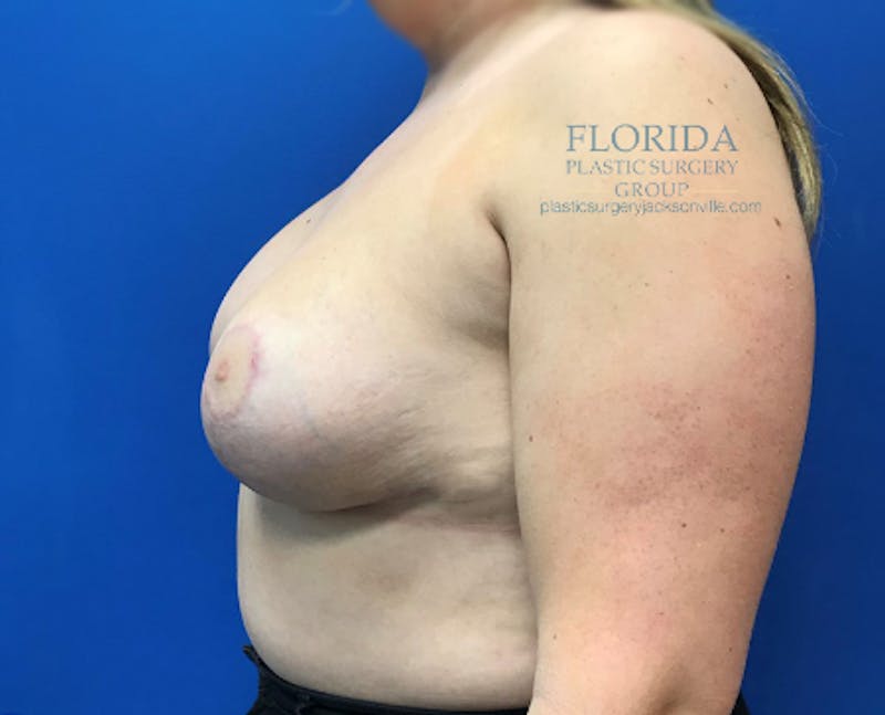 Revision Breast Surgery Before & After Gallery - Patient 154994446 - Image 6