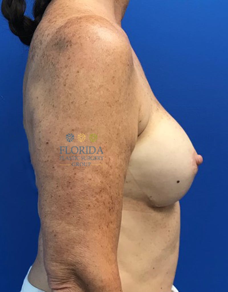 Revision Breast Surgery Before & After Gallery - Patient 154994475 - Image 5