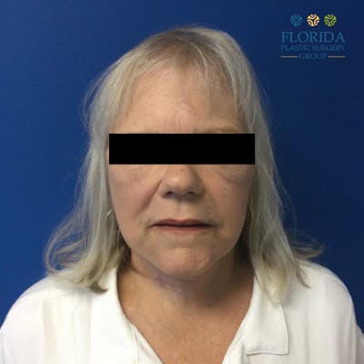 Facial Rejuvenation Before & After Gallery - Patient 173728248 - Image 1