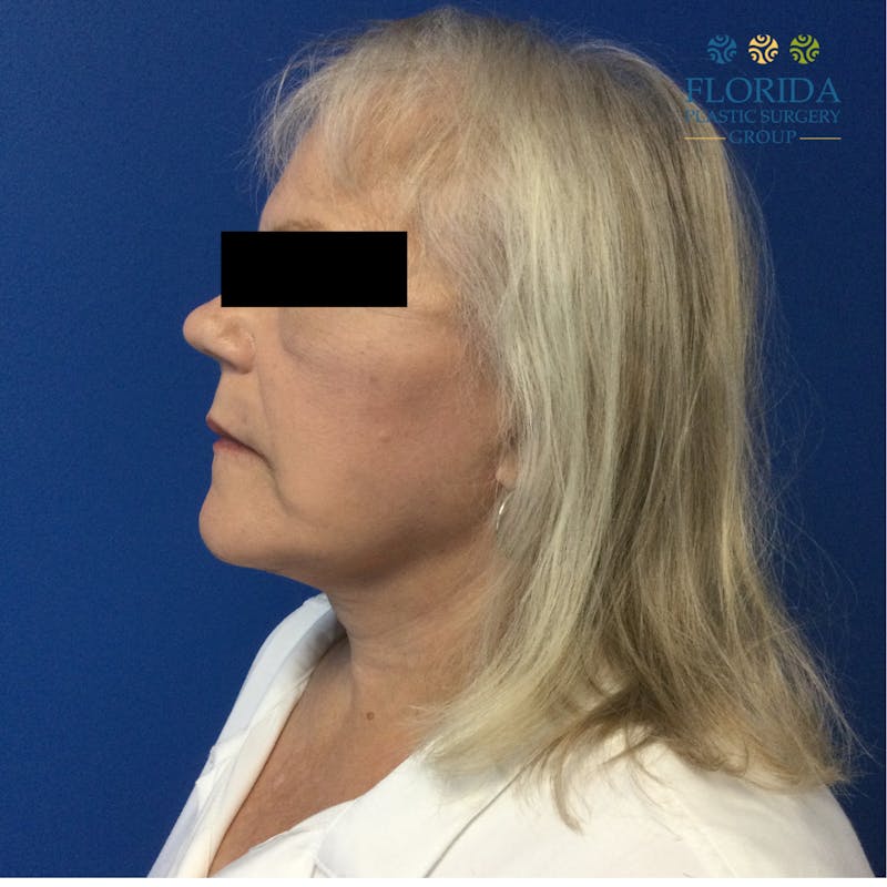 Facial Rejuvenation Before & After Gallery - Patient 173728248 - Image 3