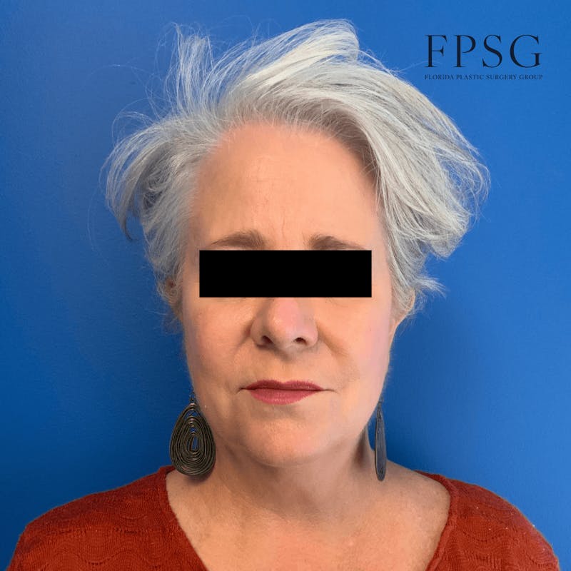 Facial Rejuvenation Before & After Gallery - Patient 173997348 - Image 1