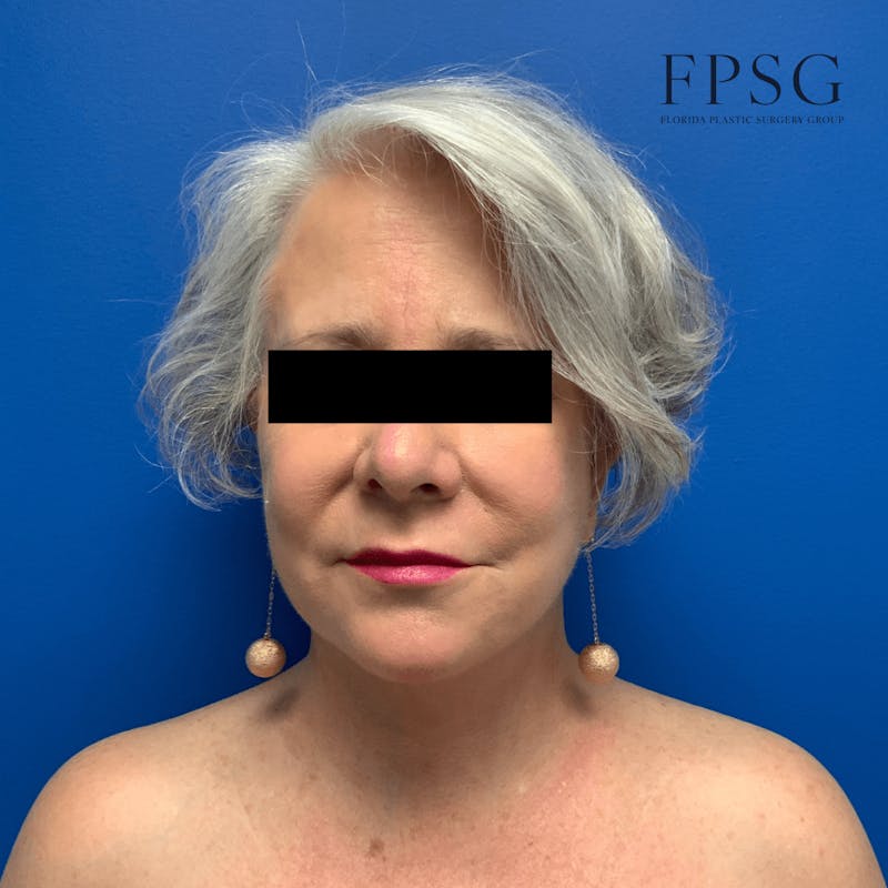 Facial Rejuvenation Before & After Gallery - Patient 173997348 - Image 2