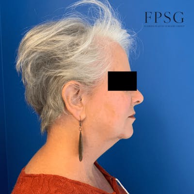 Deep Plane Neck Lift Before & After Gallery - Patient 173997409 - Image 1
