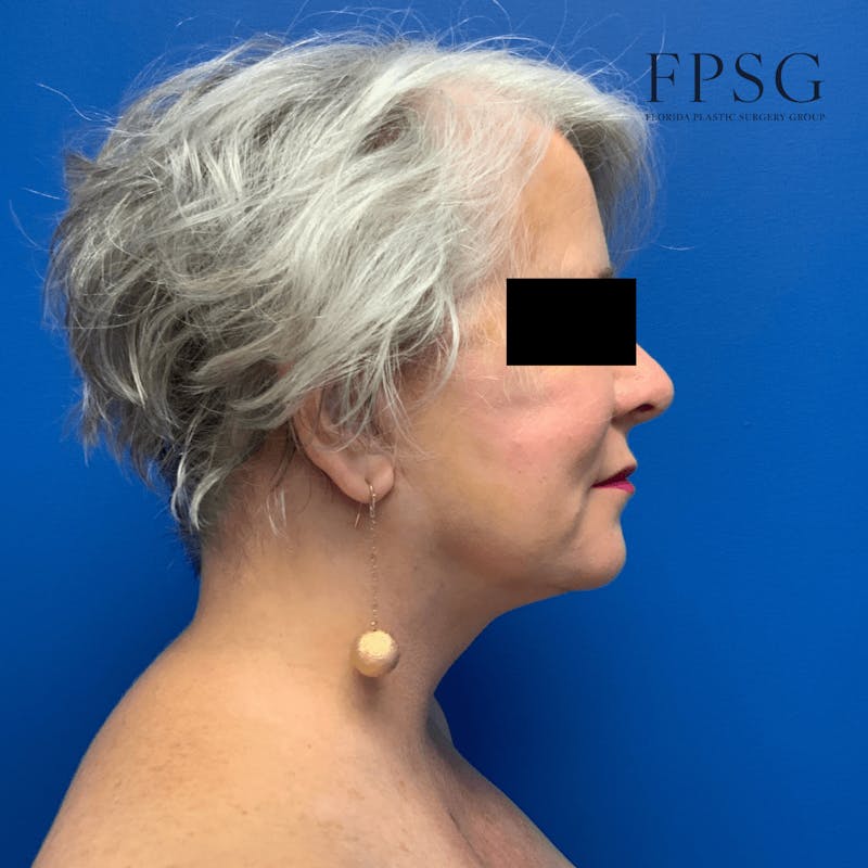 Facial Rejuvenation Before & After Gallery - Patient 173997348 - Image 4