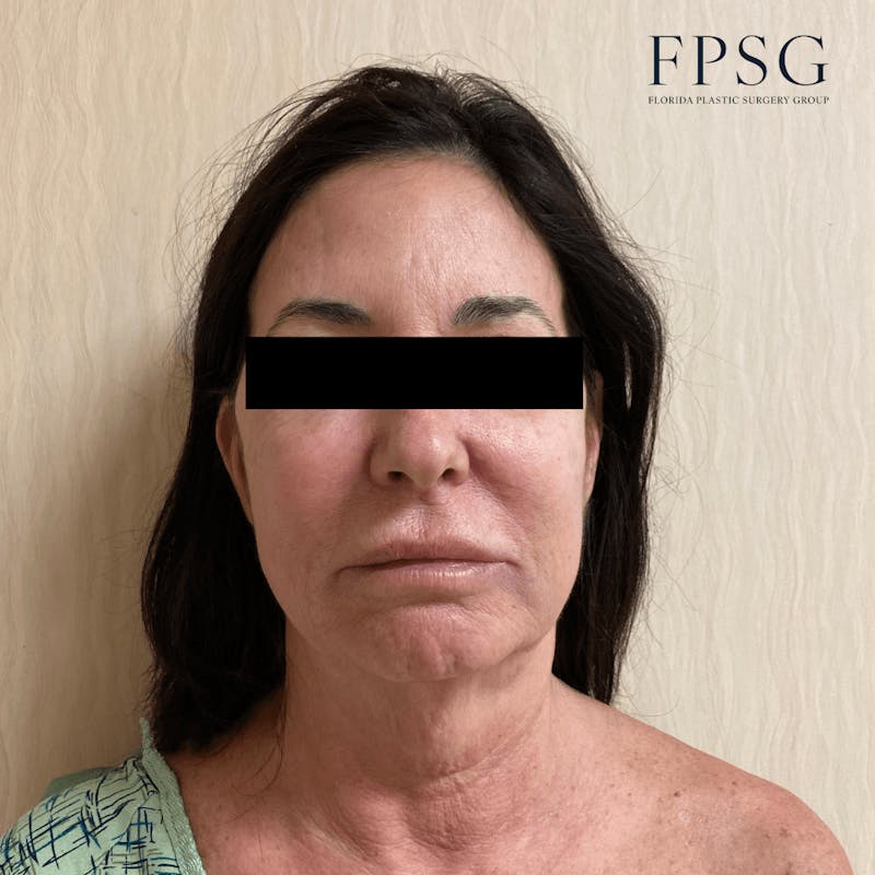 Facial Rejuvenation Before & After Gallery - Patient 173997386 - Image 1