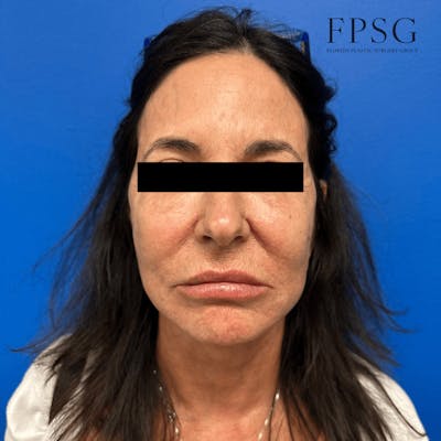 Facial Rejuvenation Before & After Gallery - Patient 173997386 - Image 2