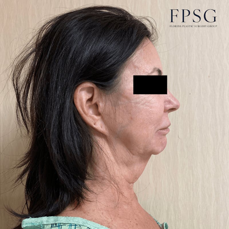 Deep Plane Neck Lift Before & After Gallery - Patient 173997411 - Image 1
