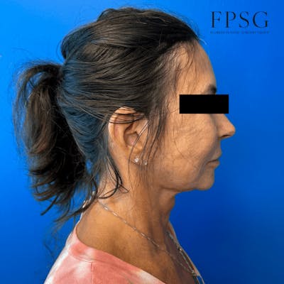 Deep Plane Neck Lift Before & After Gallery - Patient 173997411 - Image 2
