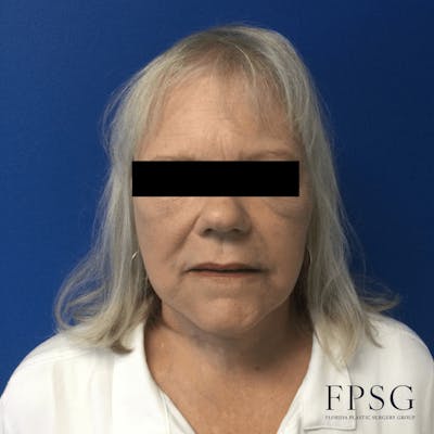 Facial Rejuvenation Before & After Gallery - Patient 173997372 - Image 2