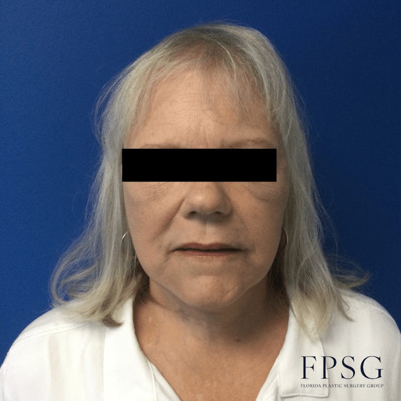 Facial Rejuvenation Before & After Gallery - Patient 173997372 - Image 2