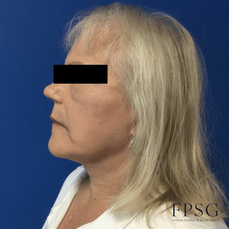 Facial Rejuvenation Before & After Gallery - Patient 173997372 - Image 3