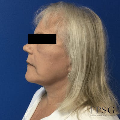 Deep Plane Neck Lift Before & After Gallery - Patient 173997410 - Image 1