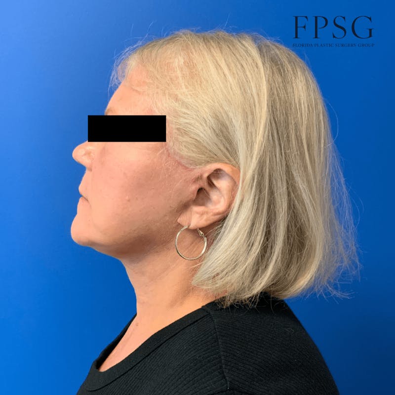 Deep Plane Neck Lift Before & After Gallery - Patient 173997410 - Image 2
