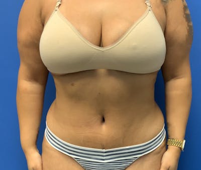 Abdominoplasty Before & After Gallery - Patient 226553 - Image 2