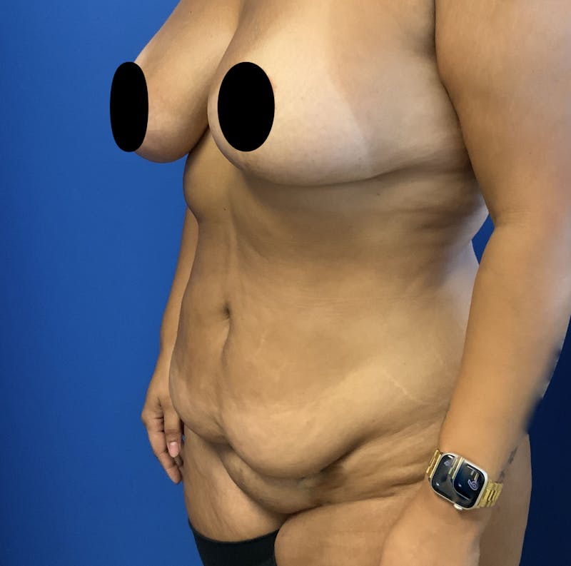 Abdominoplasty Before & After Gallery - Patient 226553 - Image 3