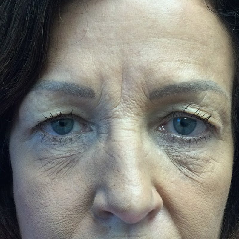 Blepharoplasty Before & After Gallery - Patient 720902 - Image 1