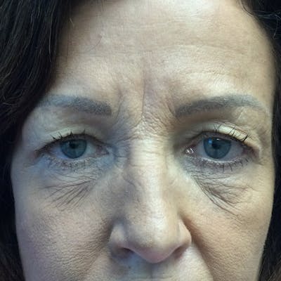Blepharoplasty Before & After Gallery - Patient 720902 - Image 1