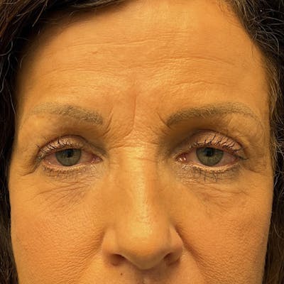 Blepharoplasty Before & After Gallery - Patient 720902 - Image 2