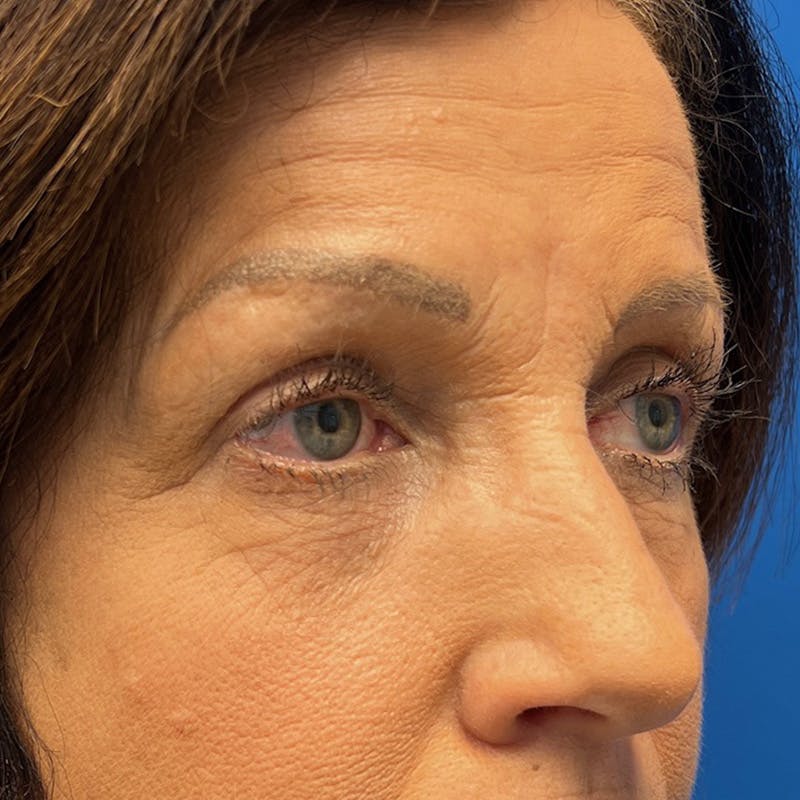 Blepharoplasty Before & After Gallery - Patient 720902 - Image 4
