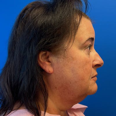 Deep Plane Neck Lift Before & After Gallery - Patient 178058 - Image 1