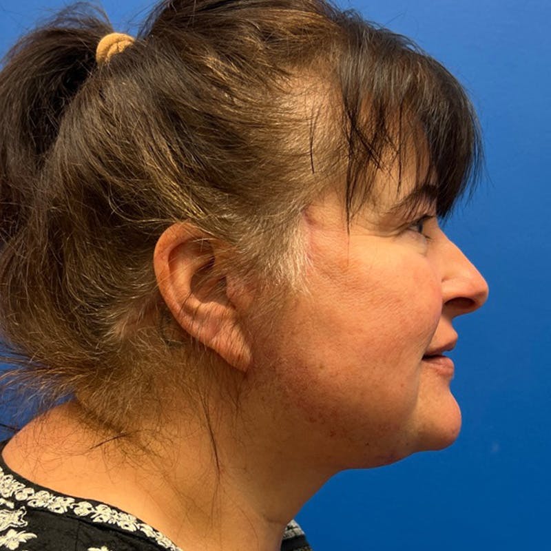 Deep Plane Neck Lift Before & After Gallery - Patient 178058 - Image 2