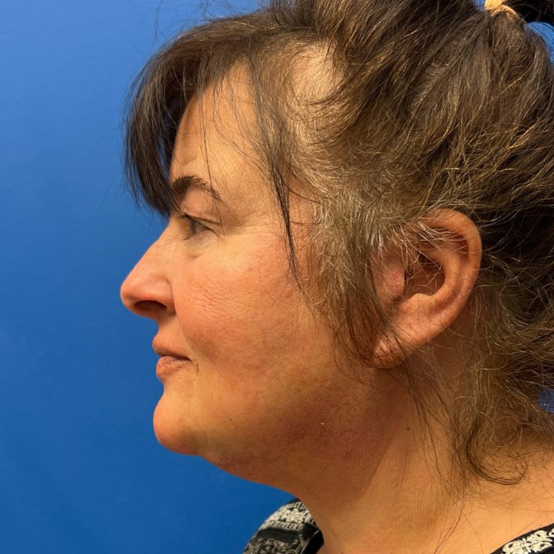 Deep Plane Neck Lift Before & After Gallery - Patient 178058 - Image 4