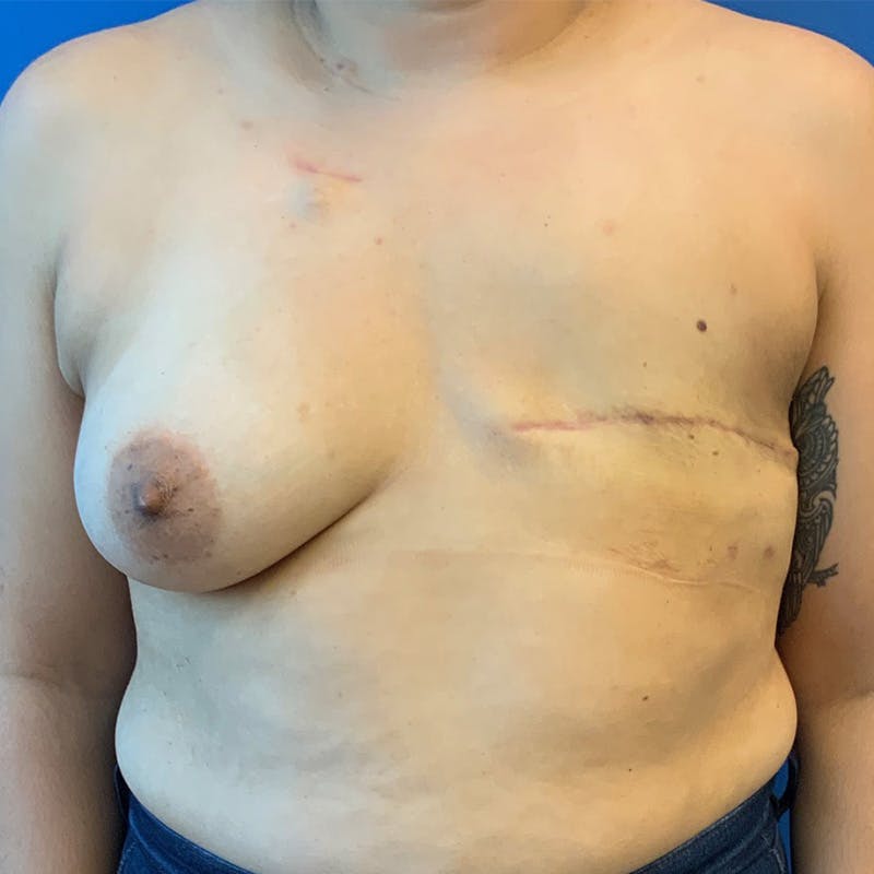 DIEP Flap Reconstruction Before & After Gallery - Patient 663378 - Image 1