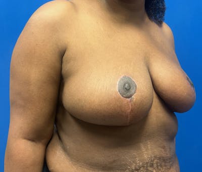 Breast Reduction Before & After Gallery - Patient 333651 - Image 2
