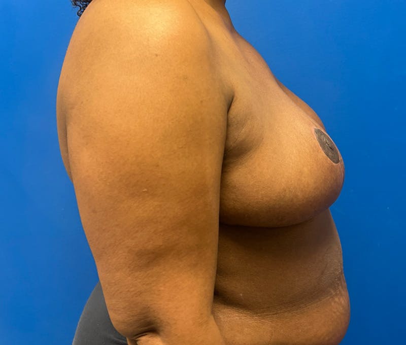 Breast Reduction Before & After Gallery - Patient 333651 - Image 4