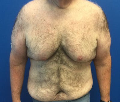 Liposuction Before & After Gallery - Patient 174083 - Image 1