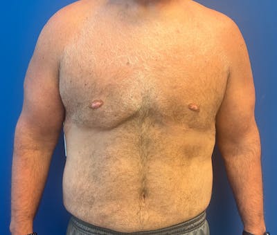 Liposuction Before & After Gallery - Patient 174083 - Image 2