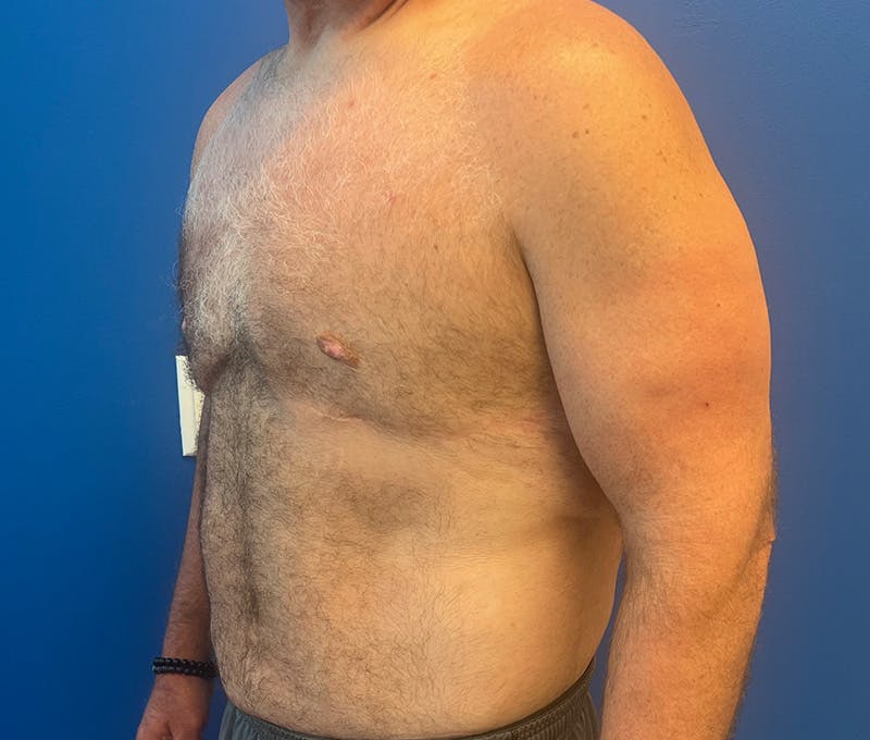 Liposuction Before & After Gallery - Patient 174083 - Image 4