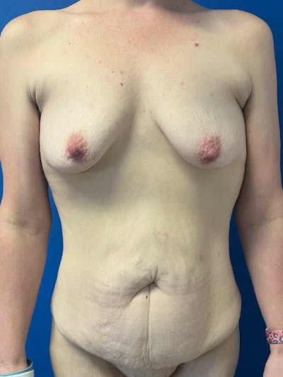 Lower Body Lift Before & After Gallery - Patient 124299 - Image 1