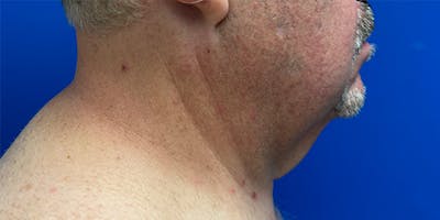 Deep Plane Neck Lift Before & After Gallery - Patient 306043 - Image 1