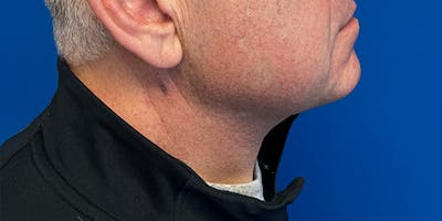 Deep Plane Neck Lift Before & After Gallery - Patient 306043 - Image 2