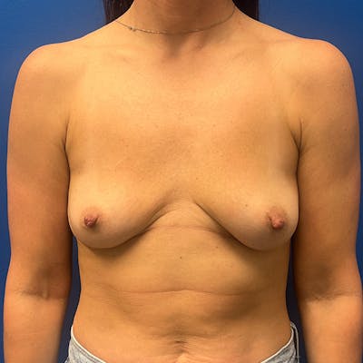Breast Implant Removal Before & After Gallery - Patient 168204 - Image 2