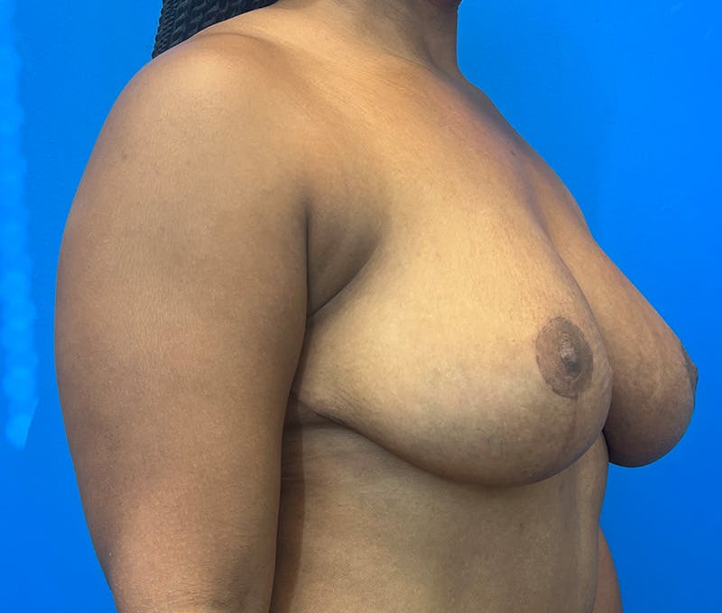 Breast Reduction Before & After Gallery - Patient 933083 - Image 4